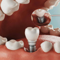 How Much Do Dental Implants Cost in Orange County, CA?