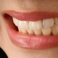 How Much Do Veneers Cost in Orange County, CA?