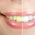 The Difference Between Aesthetic and Cosmetic Dentistry: A Comprehensive Guide