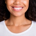 What is the Cost of Teeth Whitening in Orange County?