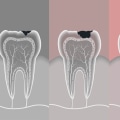 What Else Do Endodontists Do Besides Root Canals?