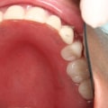 How Much Does a Root Canal Cost in Orange County, CA?