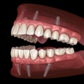 What is the Average Cost of a Dental Implant Procedure in Orange County?