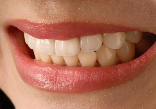 How Much Do Veneers Cost in Orange County, CA?