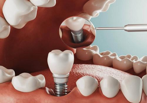 How Much Does it Cost to Get Dental Implants in Orange County, CA?