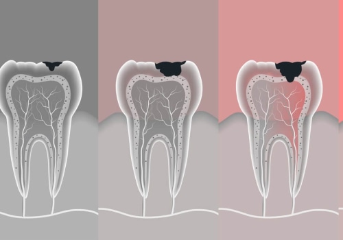 What Else Do Endodontists Do Besides Root Canals?