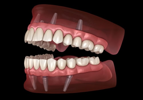 What is the Average Cost of a Dental Implant Procedure in Orange County?